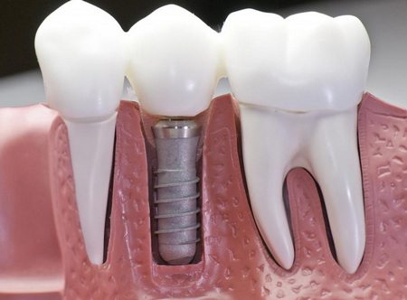 Зубные импланты – лучший способ снова смело улыбаться